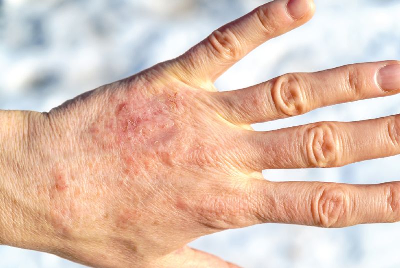 Elderly lady dry skin psoriasis